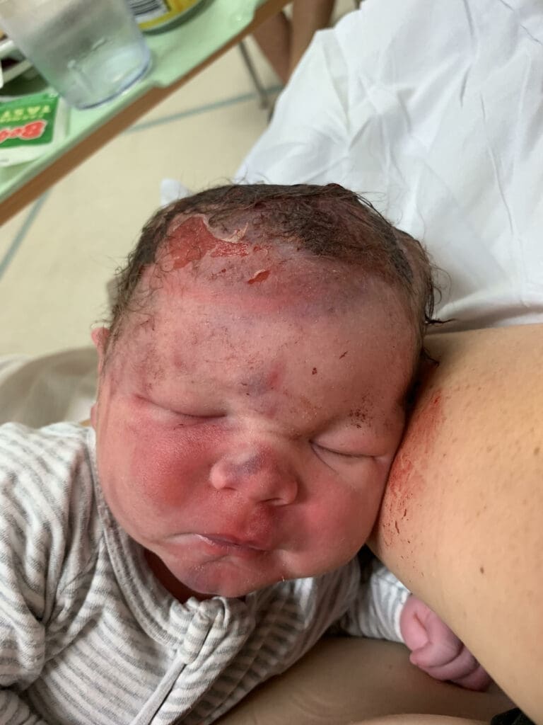 Failed vacuum delivery with 3rd degree tear and prolapse – Alison's story 1 failed vacuum delivery