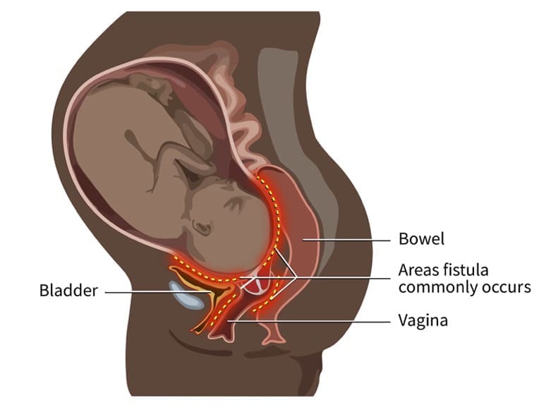 Fistula 1 Fistula Image